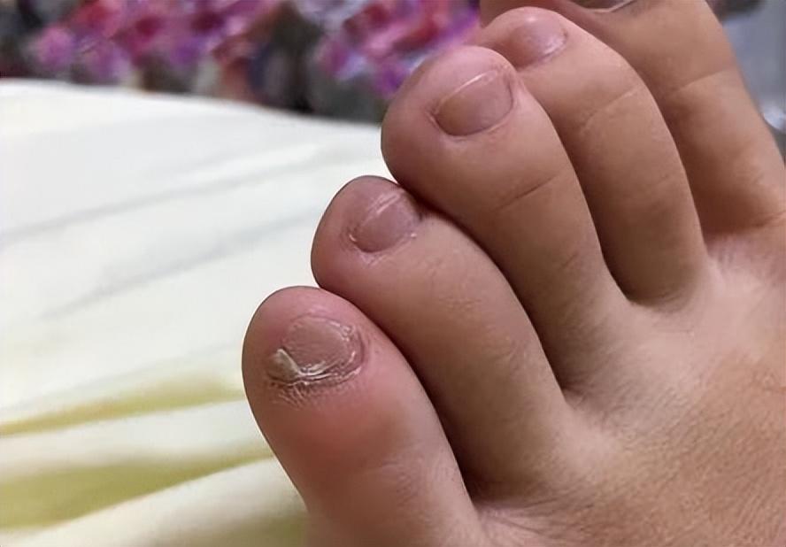 小脚趾指甲分成两瓣的人,到底是什么来历?你的指甲是这样吗?