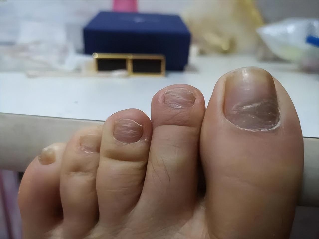 小脚趾指甲分成两瓣的人,到底是什么来历?你的指甲是这样吗?