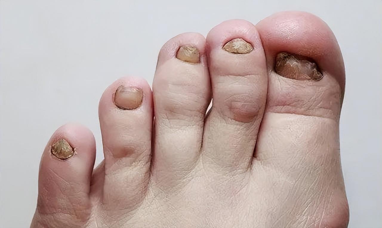 小脚趾指甲分成两瓣的人,到底是什么来历?你的指甲是这样吗?