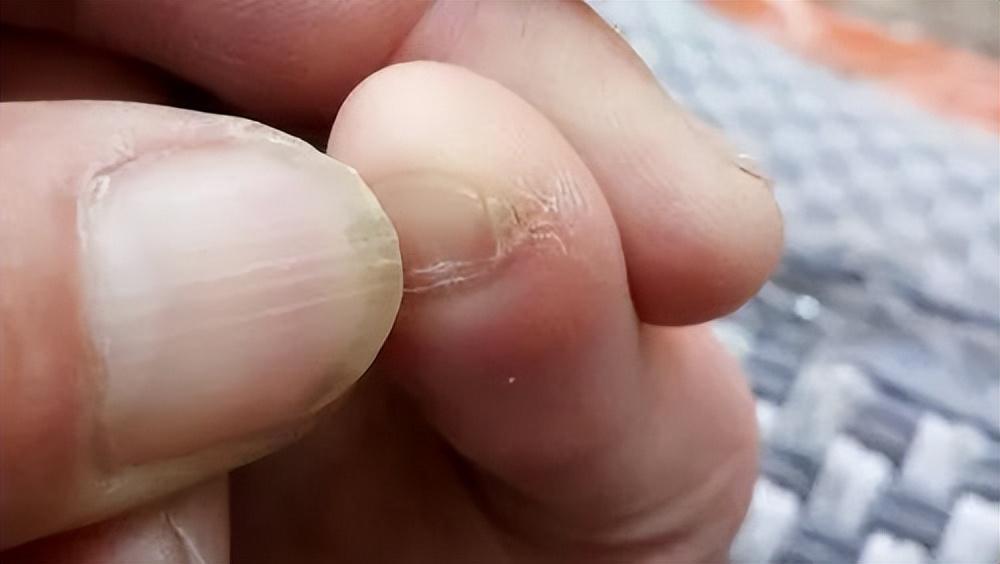 小脚趾指甲分成两瓣的人,到底是什么来历?你的指甲是这样吗?