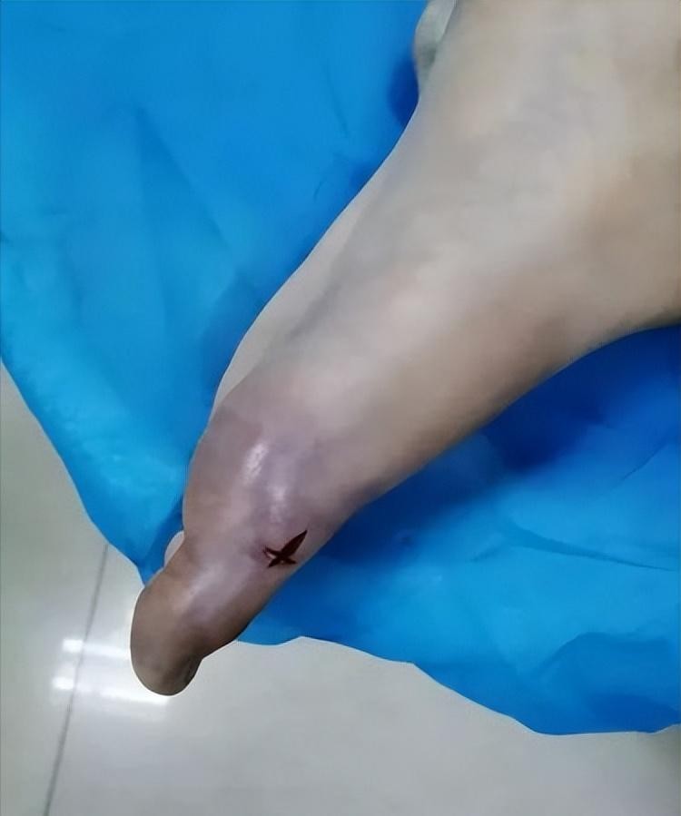 被咬后出现严重肾衰,人称“老婆改嫁蛇”,圆斑蝰到底多缺德?