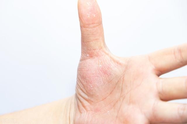 汗疱疹是不是越挠越大(夏天磨人的小妖精) 汗疱疹是不是越挠越大(夏天磨人的小妖精)