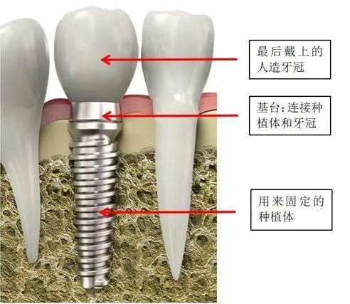 种牙价格什么时间能集采(种牙集采预计降幅达八成) 种牙价格什么时间能集采 种牙集采预计降幅达八成