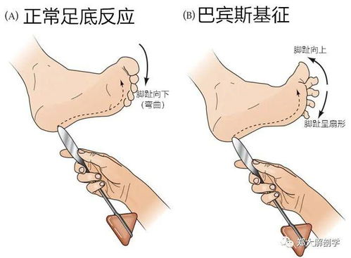 障碍运动(障碍运动项目)